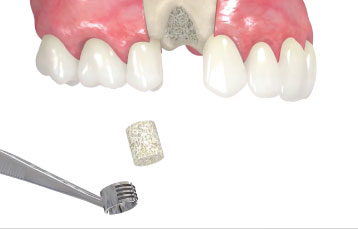 Straumann Allograft Bone Ring Molar Technique
