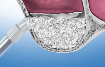 Sinus Lift Surgery For Dental Implants at ORA
