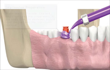 SIC invent Dental Implant, Prosthetic Animation, Single Crown Closed
