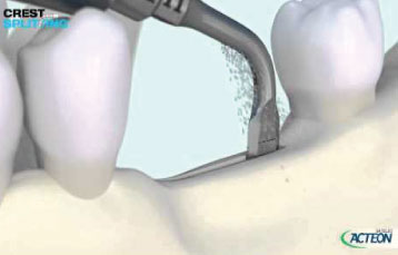PIEZOTOME® Crest Splitting 3D Protocol