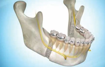 Orthognathic Surgery Animation Staten Island